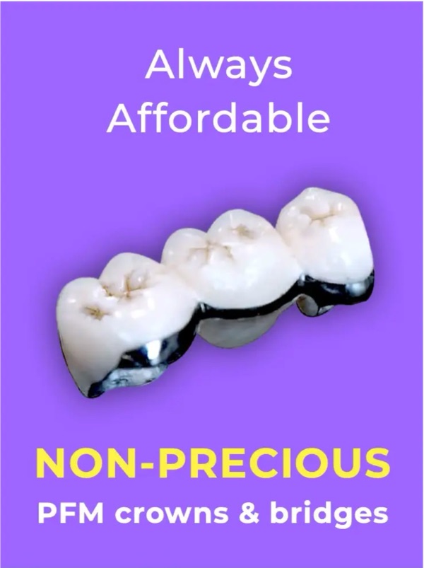 Always affordable non-precious PFM crowns and bridges